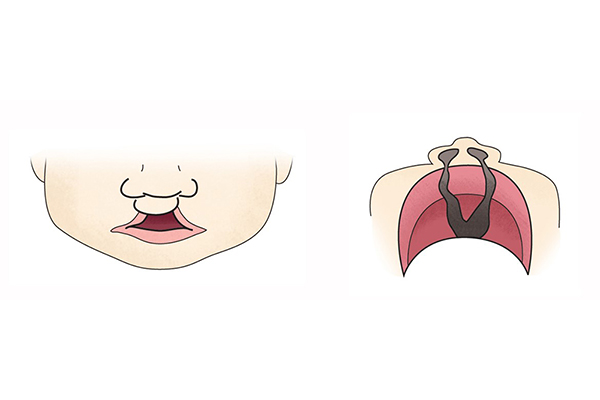 가장 흔한 선천성 안면기형 구순구개열