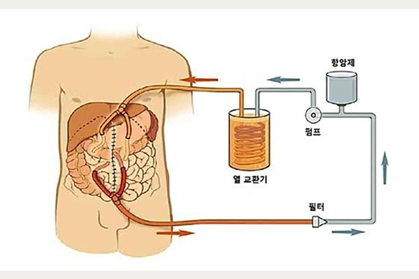 충수염부터 복막가성점액종까지 충수에 생길 수 있는 다양한 질환들