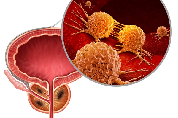 [암예방Q&A] 남성 암 발생순위 4위→2위로 '껑충' 전립선암 