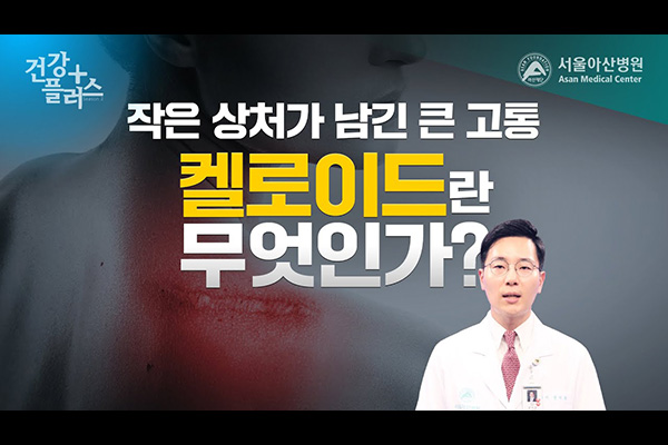[건강플러스]작은 상처가 남긴 큰 고통, '켈로이드'