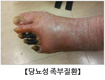 당뇨병성 족부 이미지