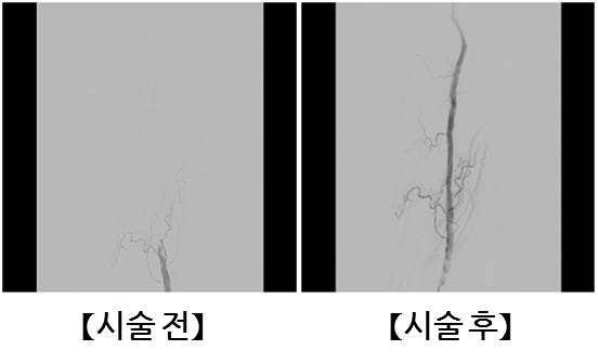 시술 전 후 비교