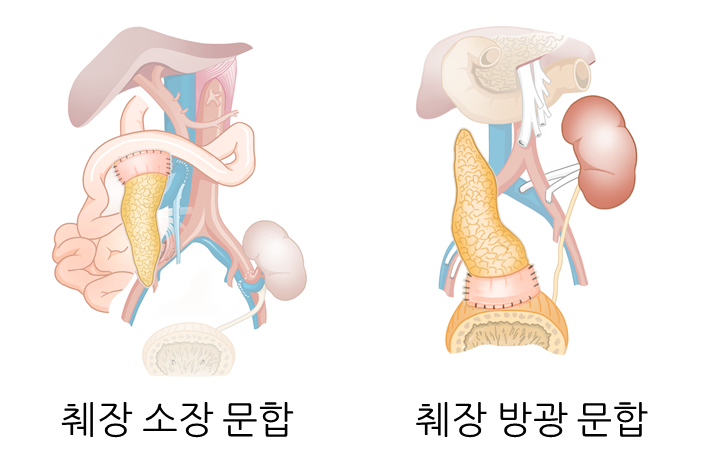 췌장 이식 방법