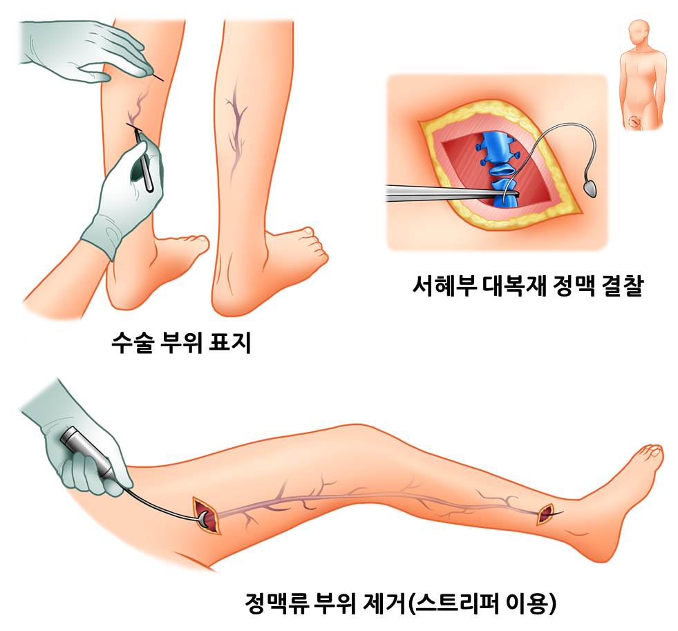 하지정맥류 치료 및 통증 없는 회복을 위한 노하우