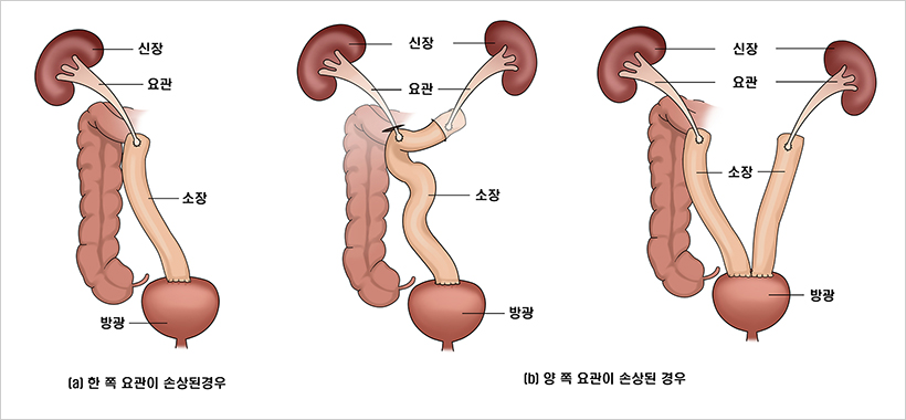 소장 요관 재건술 모식도