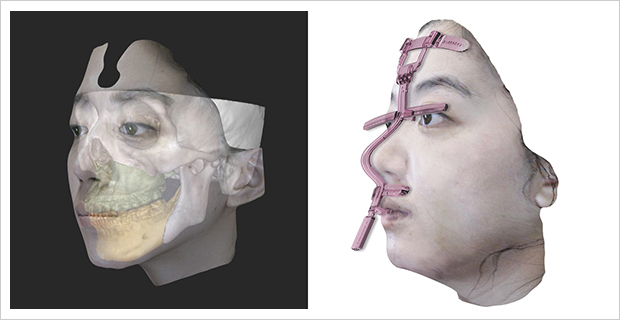 아웅수논씨의 수술에 사용된 3D 컴퓨터 시뮬레이션과 3D 프린팅