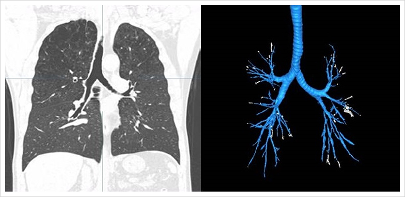 흉부 CT 사진(좌)과 기관지 인공지능 분석 결과(우)