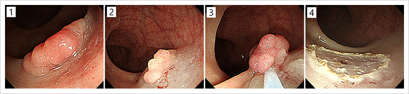 대장선종이 내시경으로 제거되는 모습