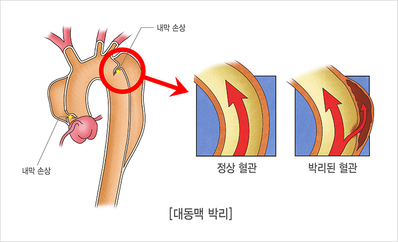 대동맥 박리 질환 설명