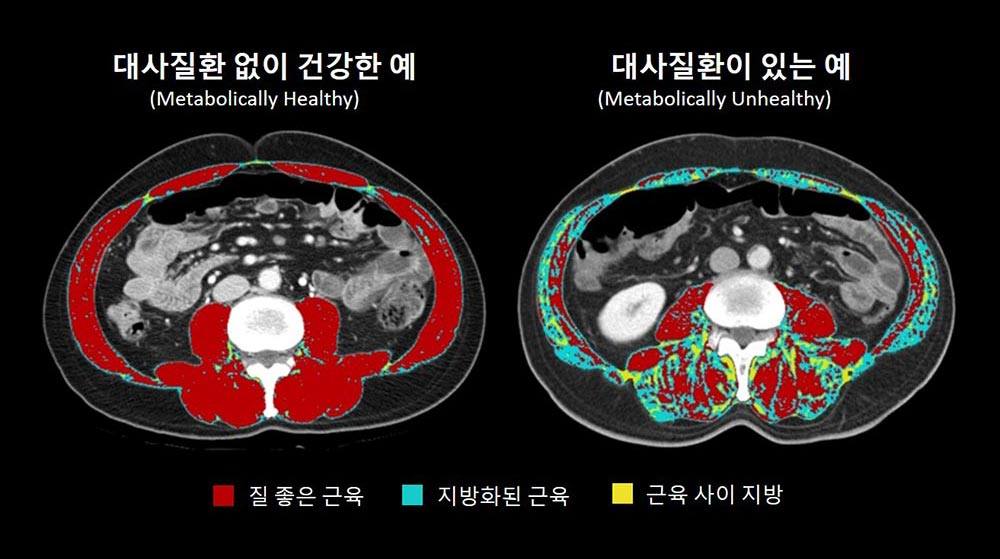 대사질환 없이 건강한 사람과 대사질환이 있는 사람의 복부 CT 영상