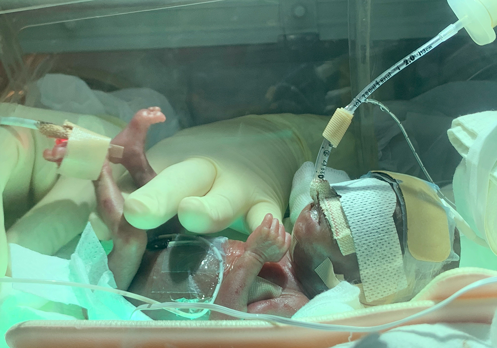 출생체중 288g으로 태어난 건우가 서울아산병원 신생아중환자실 인큐베이터에서 치료를 받고 있다(태어난 지 4일째 모습).