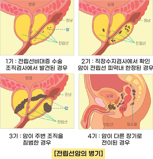 Please be aware of the initial symptoms of prostate cancer! 10
