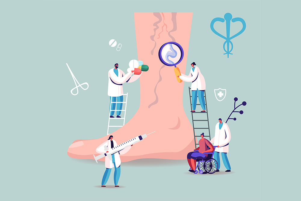 다리가 무겁고 붓는다면 하지 정맥류 주의하세요